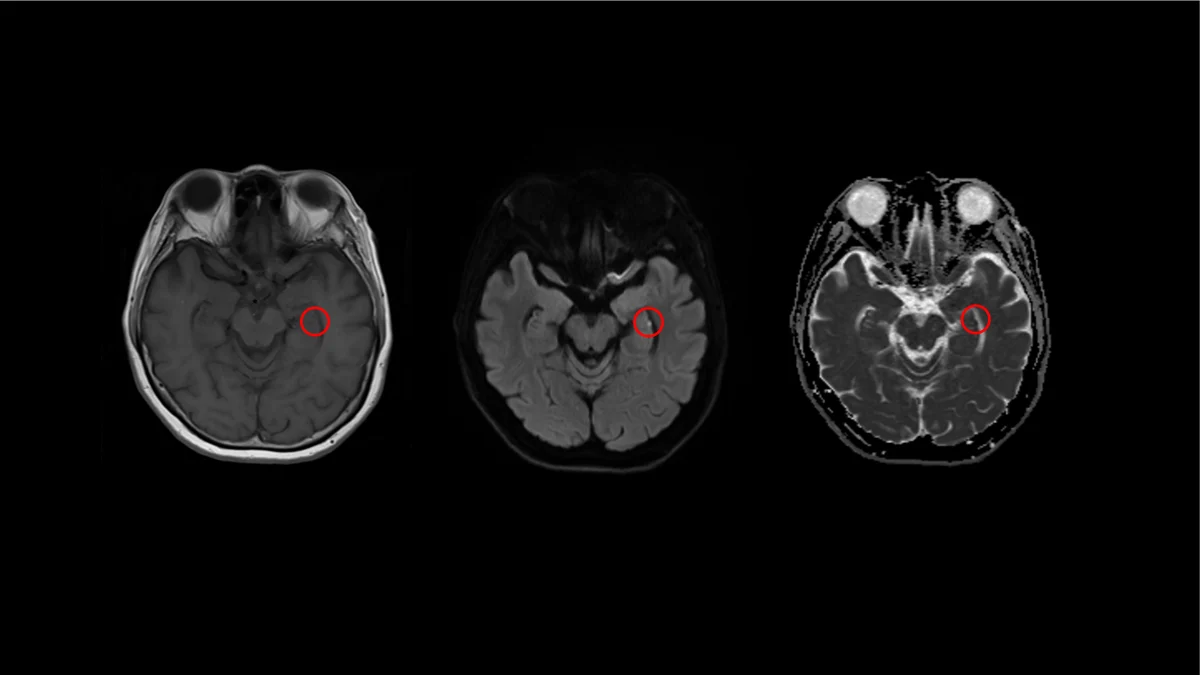 Transient Global Amnesia radiology guide application